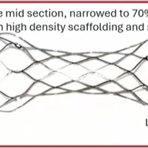 颅内支架系统SubMax——首个变径颅内支架系统，治疗以及预防颅内动脉粥样硬化患者卒中 ...